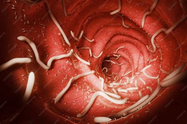 Can worms cause intestinal blockage?