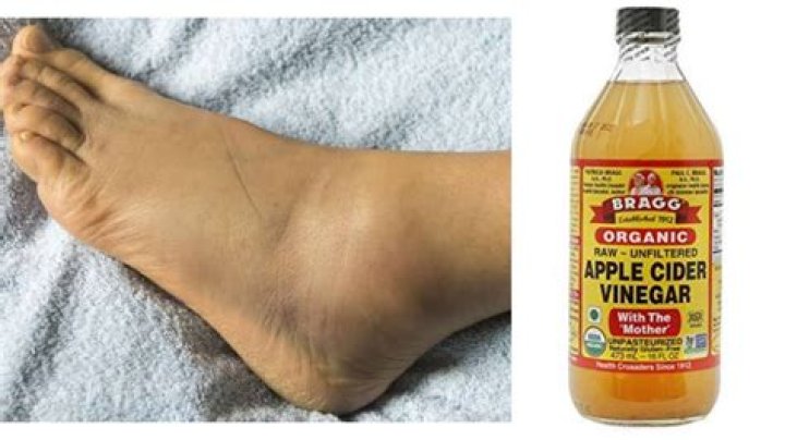 Does apple cider vinegar reduce swelling in feet?